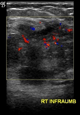 File:Abdominal wall endometriosis (Radiopaedia 25723-25886 A 1).jpg