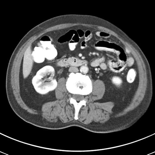 Abdominal wall metastasis from colorectal carcinoma (Radiopaedia 31016-31717 Axial C+ portal venous phase 38).jpg