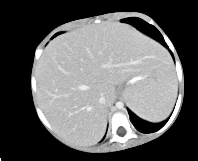 Abdominopelvic rhabdomyosarcoma (Radiopaedia 78356-90984 Axial C+ portal venous phase 45).jpg