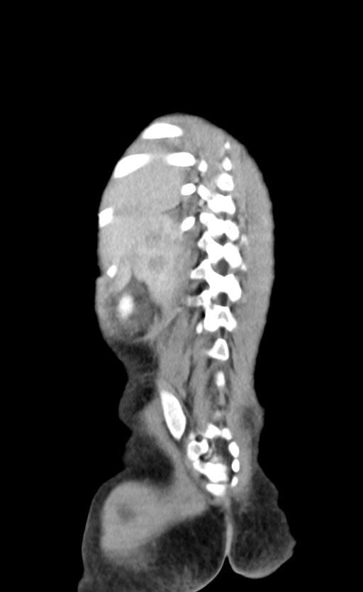 Abdominopelvic rhabdomyosarcoma (Radiopaedia 78356-90984 Coronal C+ portal venous phase 81).jpg