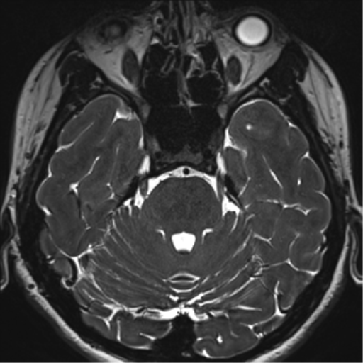 Abducens nerve palsy (Radiopaedia 51069-56648 Axial T2 fat sat 38).png