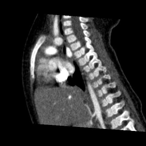 Aberrant left pulmonary artery (pulmonary sling) (Radiopaedia 42323-45435 Sagittal C+ arterial phase 30).jpg