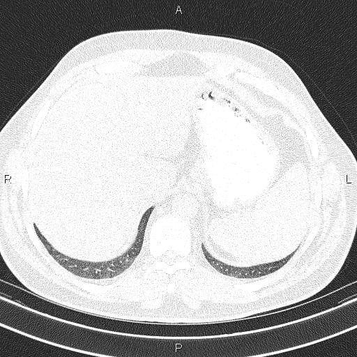 File:Aberrant right subclavian artery (Radiopaedia 87093-103354 Axial lung window 100).jpg