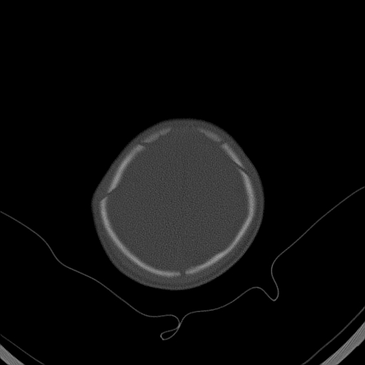 File:Accessory intraparietal suture (Radiopaedia 50584-56020 Axial bone window 41).jpg