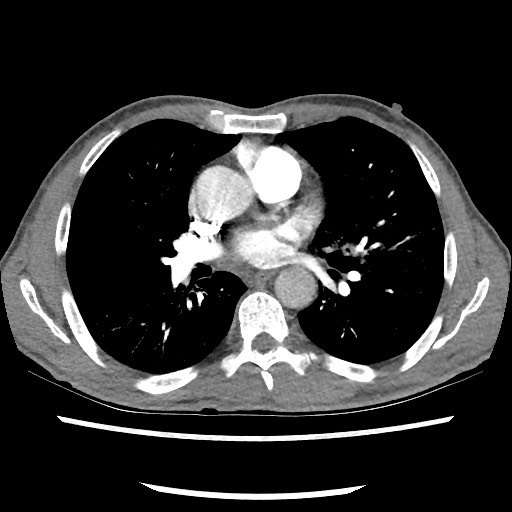 Accessory left horizontal fissure with lingular pneumonia (Radiopaedia 53763-59843 Axial C+ CTPA 50).jpg