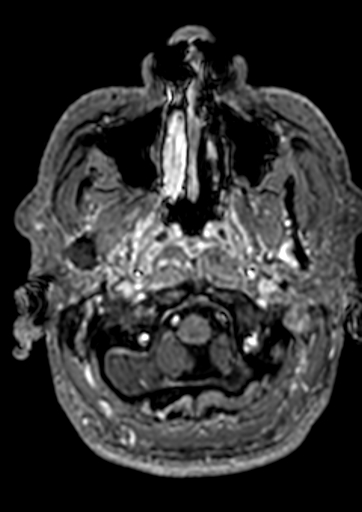 File:Accessory middle cerebral artery (Radiopaedia 73114-83828 Axial T1 C+ 181).jpg