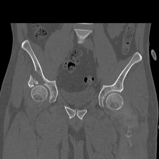 Acetabular and ilial fractures (Radiopaedia 59084-66378 Coronal bone window 21).jpg