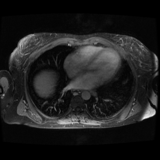 Acinar cell carcinoma of the pancreas (Radiopaedia 75442-86668 Axial T1 C+ fat sat 145).jpg