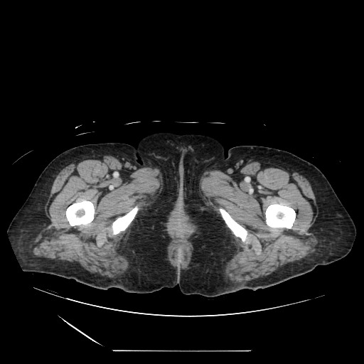 File:Acinar cell carcinoma of the pancreas (Radiopaedia 75442-86669 Axial C+ portal venous phase 161).jpg