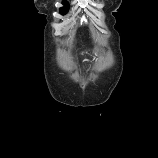 Acinar cell carcinoma of the pancreas (Radiopaedia 75442-86669 Coronal C+ portal venous phase 15).jpg