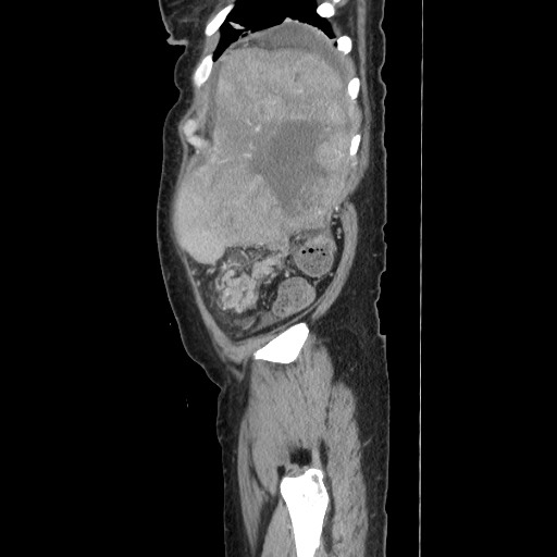 Acinar cell carcinoma of the pancreas (Radiopaedia 75442-86669 Sagittal C+ portal venous phase 166).jpg