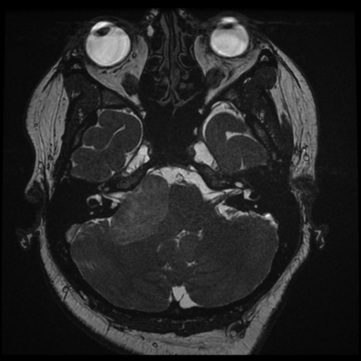 Acoustic schwannoma (Radiopaedia 57574-64536 Axial T2 29).png