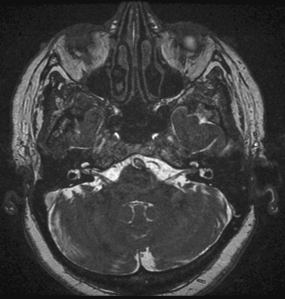 File:Acoustic schwannoma - intracanalicular (Radiopaedia 2624-6328 Axial T2 1).jpg