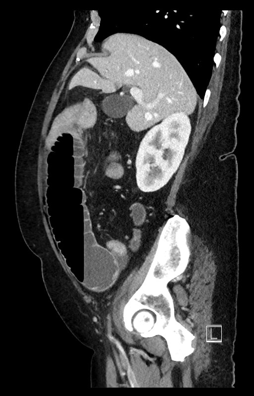Active Crohn disease (Radiopaedia 59394-66750 Sagittal C+ portal venous phase 40).jpg