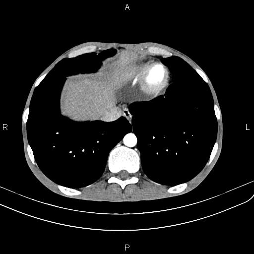 File:Active crohn disease (Radiopaedia 87133-103397 Axial C+ arterial phase 11).jpg