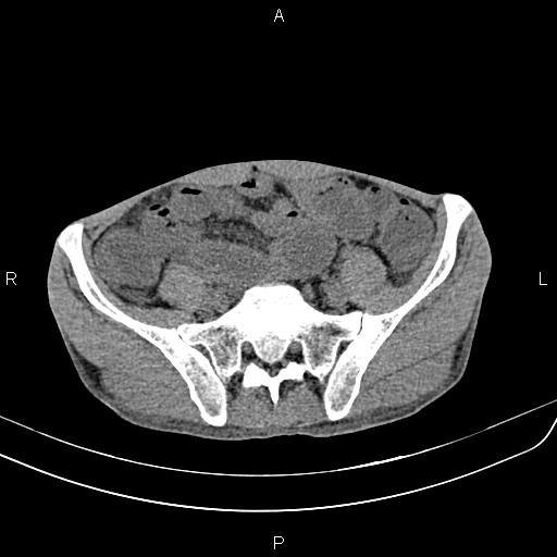 Active crohn disease (Radiopaedia 87133-103397 Axial non-contrast 76).jpg