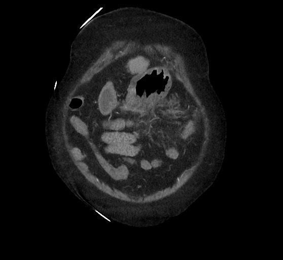 Active renal extravasation with large subcapsular and retroperitoneal hemorrhage (Radiopaedia 60975-68796 Coronal C+ arterial phase 30).jpg