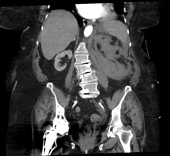 Active renal extravasation with large subcapsular and retroperitoneal hemorrhage (Radiopaedia 60975-68796 Coronal C+ arterial phase 96).jpg