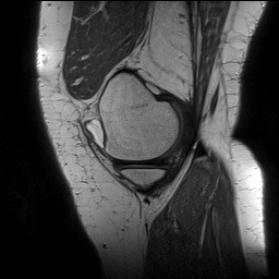 File:Acute-on-chronic transient lateral patellar dislocation with trochlear dysplasia (Radiopaedia 84099-99349 Sagittal PD 40).jpg