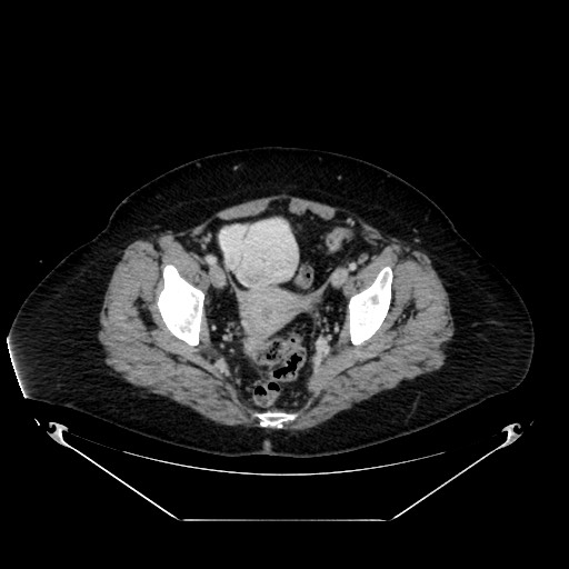 File:Acute appendicitis, heterotaxy syndrome (Radiopaedia 66884-76202 Axial 74).jpg