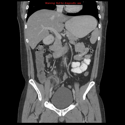 File:Acute appendicitis (Radiopaedia 10498-10973 F 15).jpg