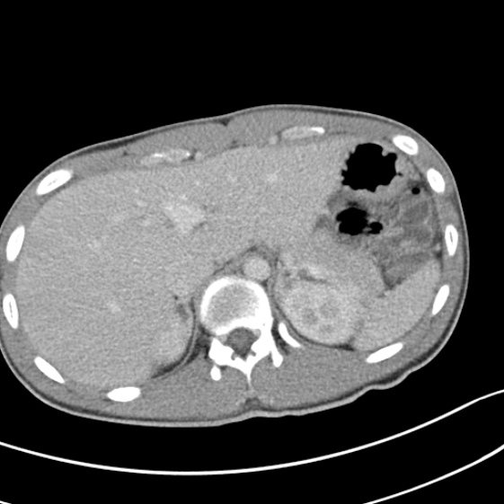 Acute appendicitis (Radiopaedia 32614-33572 Axial C+ portal venous phase 12).jpg