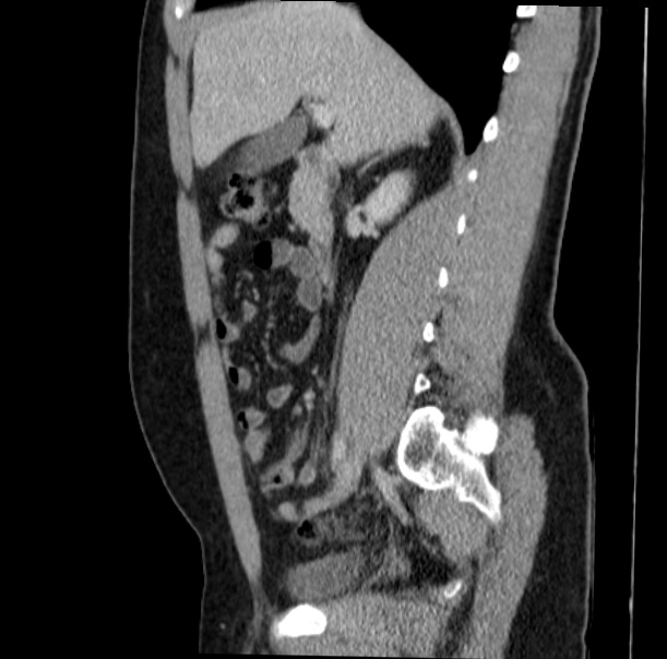 Acute appendicitis (Radiopaedia 38255-40270 Sagittal C+ portal venous phase 33).jpg