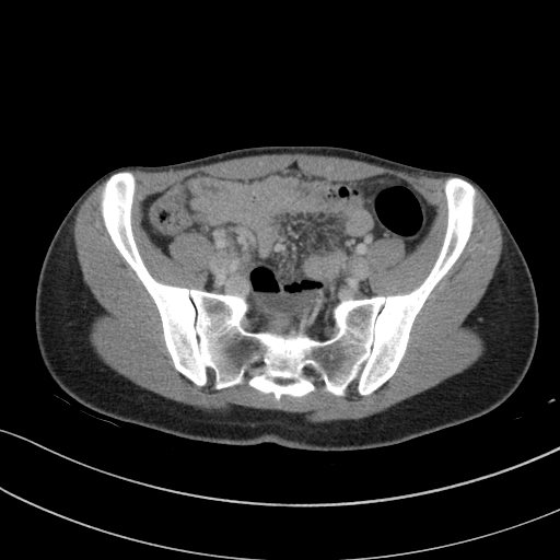 File:Acute appendicitis (Radiopaedia 62608-70901 Axial C+ portal venous phase 19).jpg