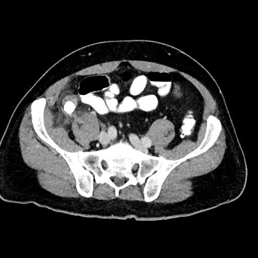 File:Acute appendicitis (Radiopaedia 77016-88960 Axial C+ portal venous phase 105).jpg