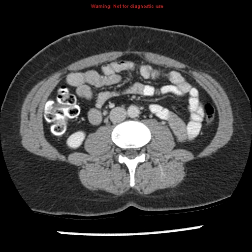 Acute appendicitis (Radiopaedia 7966-8812 C+ portal venous phase 24).jpg