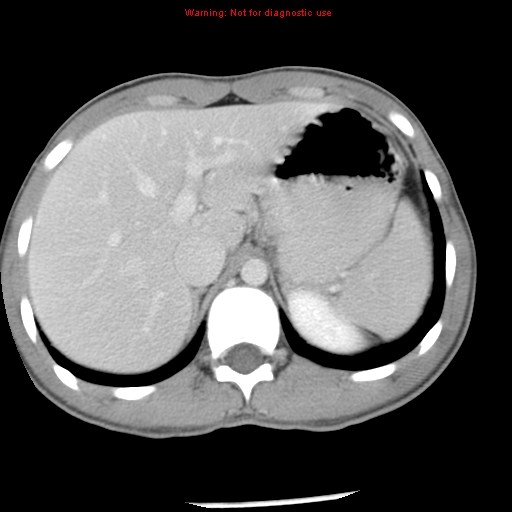 Acute appendicitis (Radiopaedia 8195-9045 Axial C+ portal venous phase 15).jpg