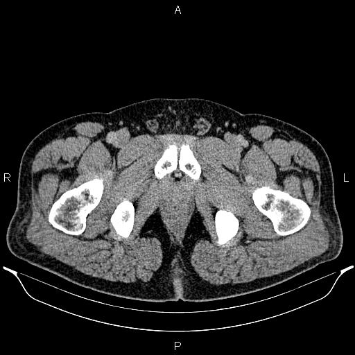 Acute appendicitis (Radiopaedia 84780-100240 Axial C+ portal venous phase 114).jpg