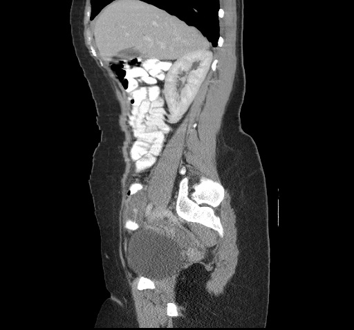 File:Acute appendicitis (Radiopaedia 9417-10099 Sagittal C+ portal venous phase 11).jpg