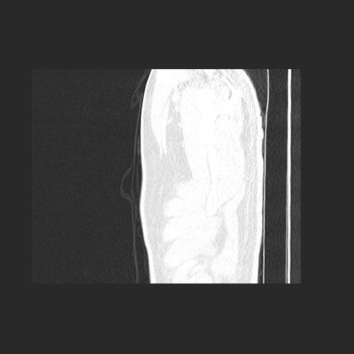 Acute appendicitis and COVID 19 pneumonia (Radiopaedia 76604-88380 Sagittal lung window 5).jpg