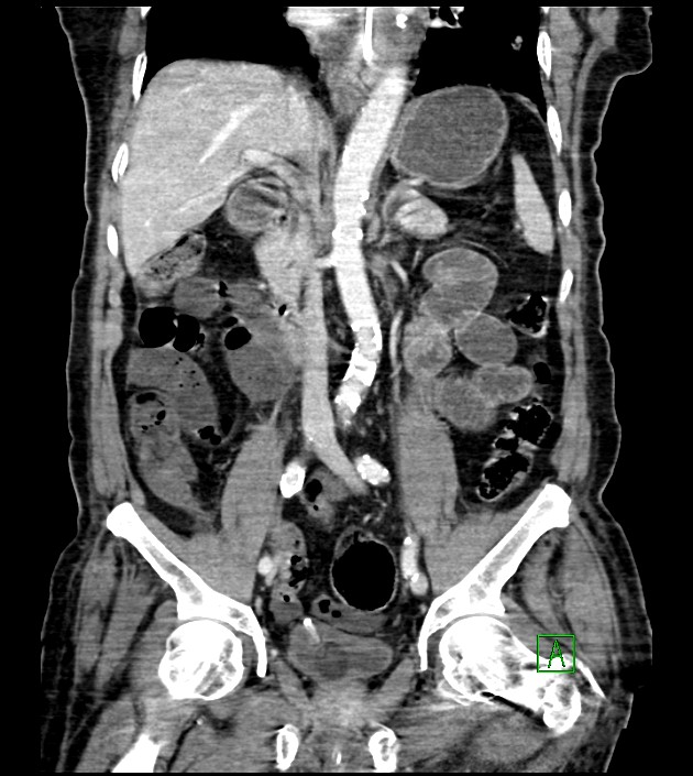 Acute arterial mesenteric ischemia (Radiopaedia 78238-90828 Coronal C+ portal venous phase 52).jpg