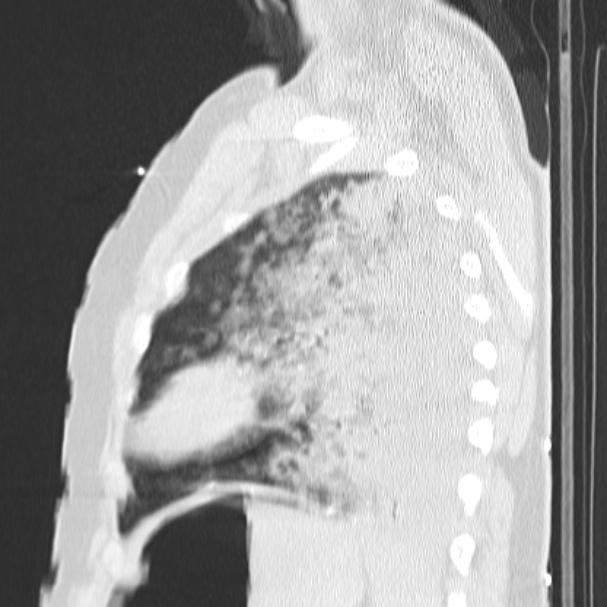 Acute aspiration pneumonitis (Radiopaedia 33605-34703 Sagittal lung window 67).jpg