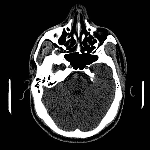 File:Acute basilar artery occlusion (Radiopaedia 43582-46985 Axial non-contrast 63).jpg