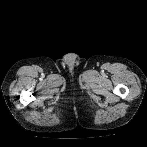 Acute cholecystitis and incidental left sided IVC (Radiopaedia 49352-54459 Axial C+ portal venous phase 177).jpg