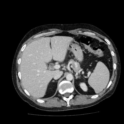 Acute cholecystitis and incidental left sided IVC (Radiopaedia 49352-54459 Axial C+ portal venous phase 46).jpg