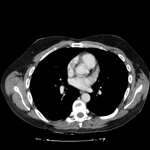 File:Acute cholecystitis and incidental left sided IVC (Radiopaedia 49352-54459 Axial C+ portal venous phase 5).jpg