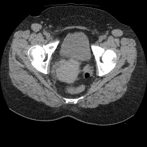 Acute cholecystitis and ureteric colic (Radiopaedia 42330-45444 Axial prone 102).jpg