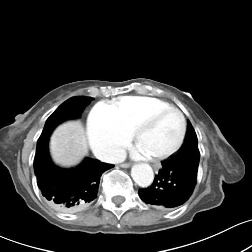 Acute cholecystitis with contained perforation (Radiopaedia 47328-51907 Axial C+ portal venous phase 4).png