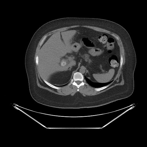 File:Acute cholecystitis with tensile fundus sign (Radiopaedia 71394-81723 Axial non-contrast 11).jpg