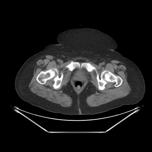 File:Acute cholecystitis with tensile fundus sign (Radiopaedia 71394-81723 Axial non-contrast 118).jpg