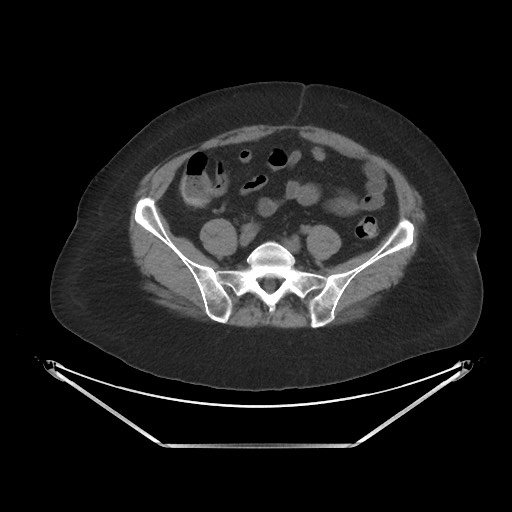 Acute cholecystitis with tensile fundus sign (Radiopaedia 71394-81723 Axial non-contrast 81).jpg
