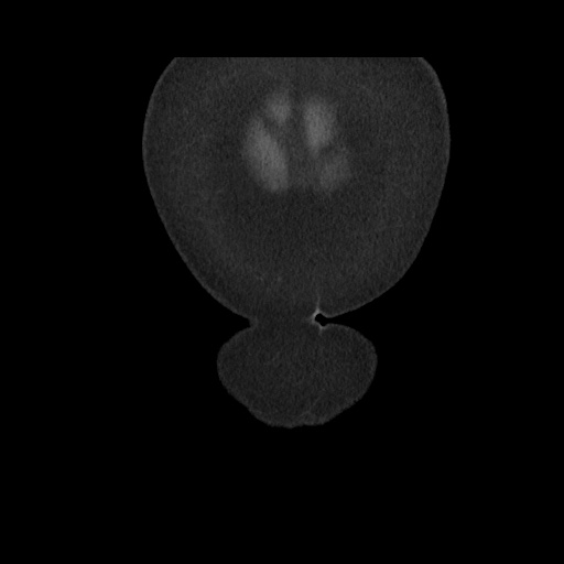 Acute cholecystitis with tensile fundus sign (Radiopaedia 71394-81723 Coronal non-contrast 15).jpg