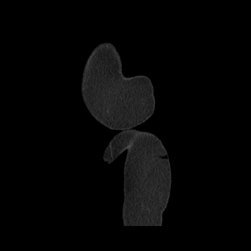 Acute cholecystitis with tensile fundus sign (Radiopaedia 71394-81723 Sagittal non-contrast 169).jpg