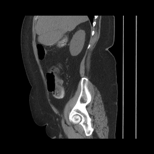Acute cholecystitis with tensile fundus sign (Radiopaedia 71394-81723 Sagittal non-contrast 61).jpg