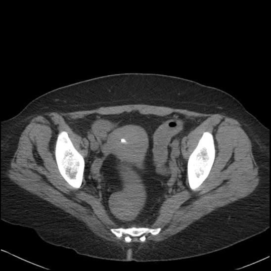 Acute colonic hemorrhage in ulcerative colitis (Radiopaedia 77415-89538 Axial non-contrast 117).jpg