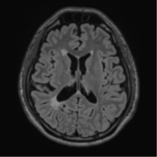 File:Acute disseminated encephalomyelitis (ADEM)- Anti-NMDA receptor encephalitis (Radiopaedia 54920-61201 Axial FLAIR 39).png